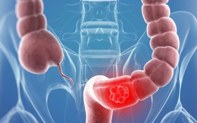 Cáncer de colon: pruebas de detección